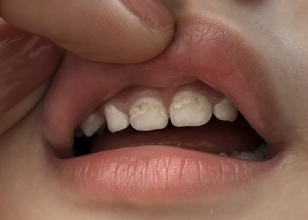 孩子不爱刷牙，牙齿都“脱矿”了！这时候还能补救吗？