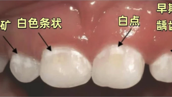 孩子不爱刷牙，牙齿都“脱矿”了！这时候还能补救吗？