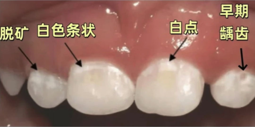 孩子不爱刷牙，牙齿都“脱矿”了！这时候还能补救吗？