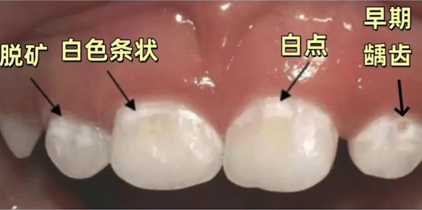 孩子不爱刷牙，牙齿都“脱矿”了！这时候还能补救吗？
