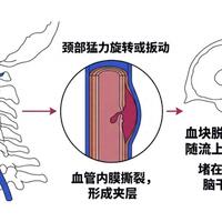 40岁兄弟脖子咔咔响多半没事，但猛扳真出过事